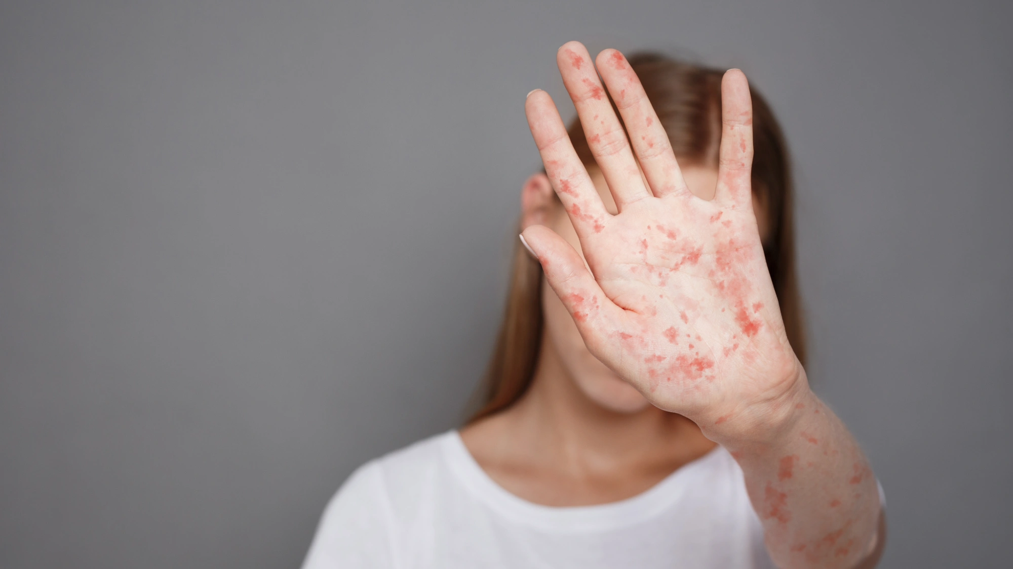 Woman with measles covering her face with a rash-covered hand.