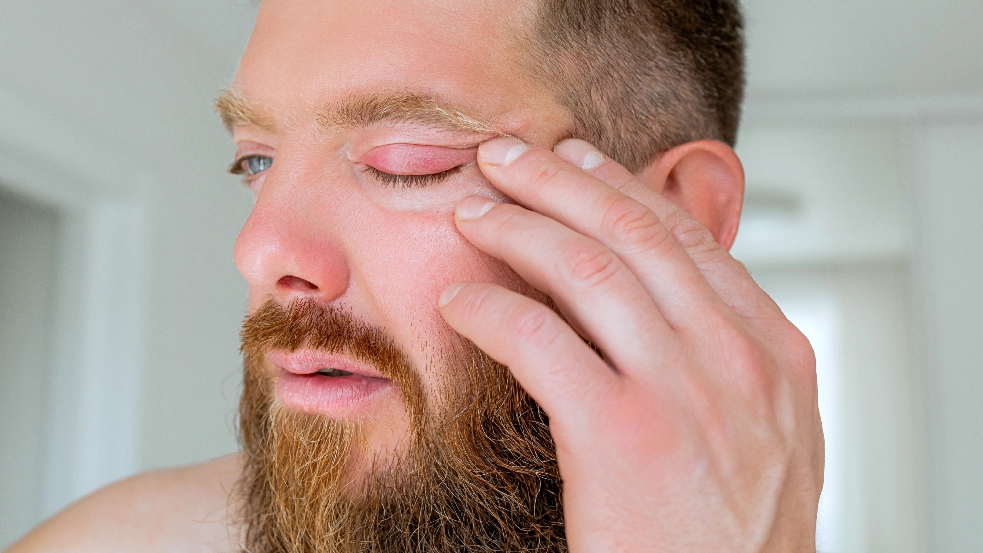 Man with a swollen eyelid caused by a staph infection.
