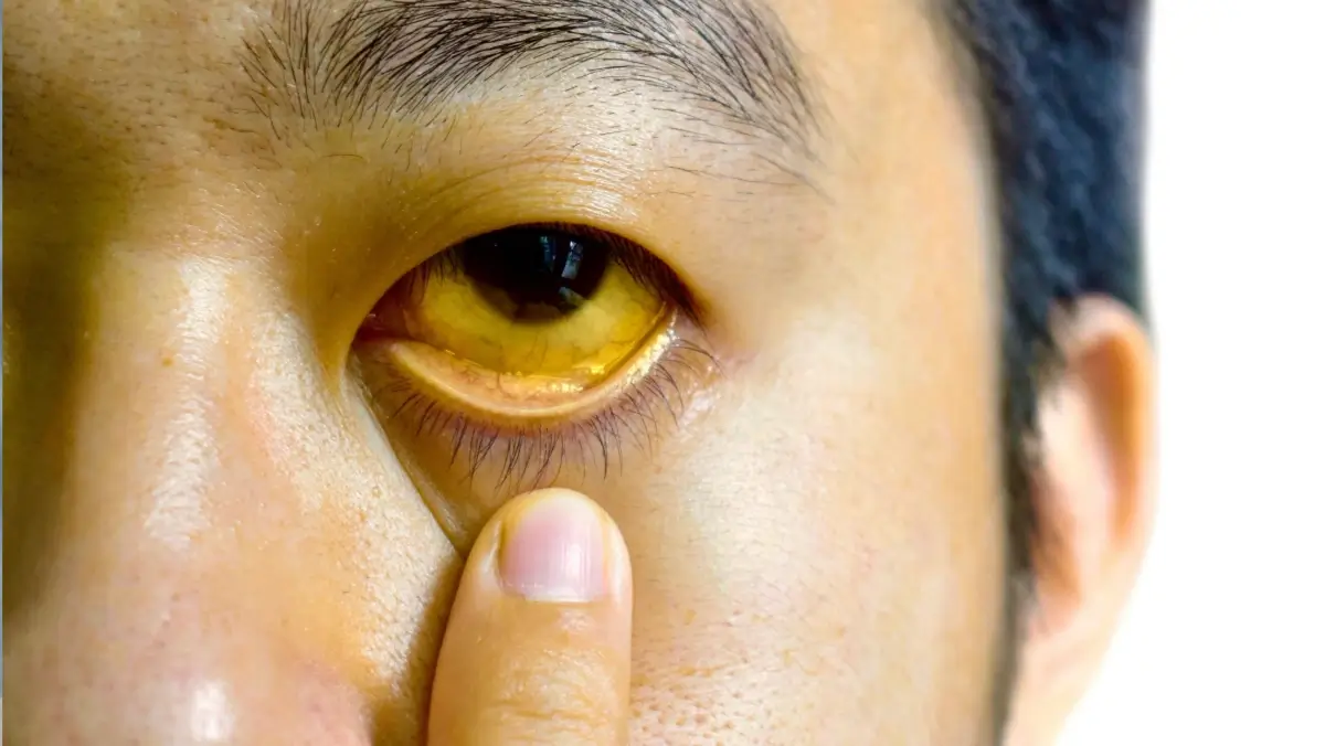 Man with noticeably yellow skin and eyes, illustrating jaundice and possible underlying causes of yellowing that may need medical attention.
