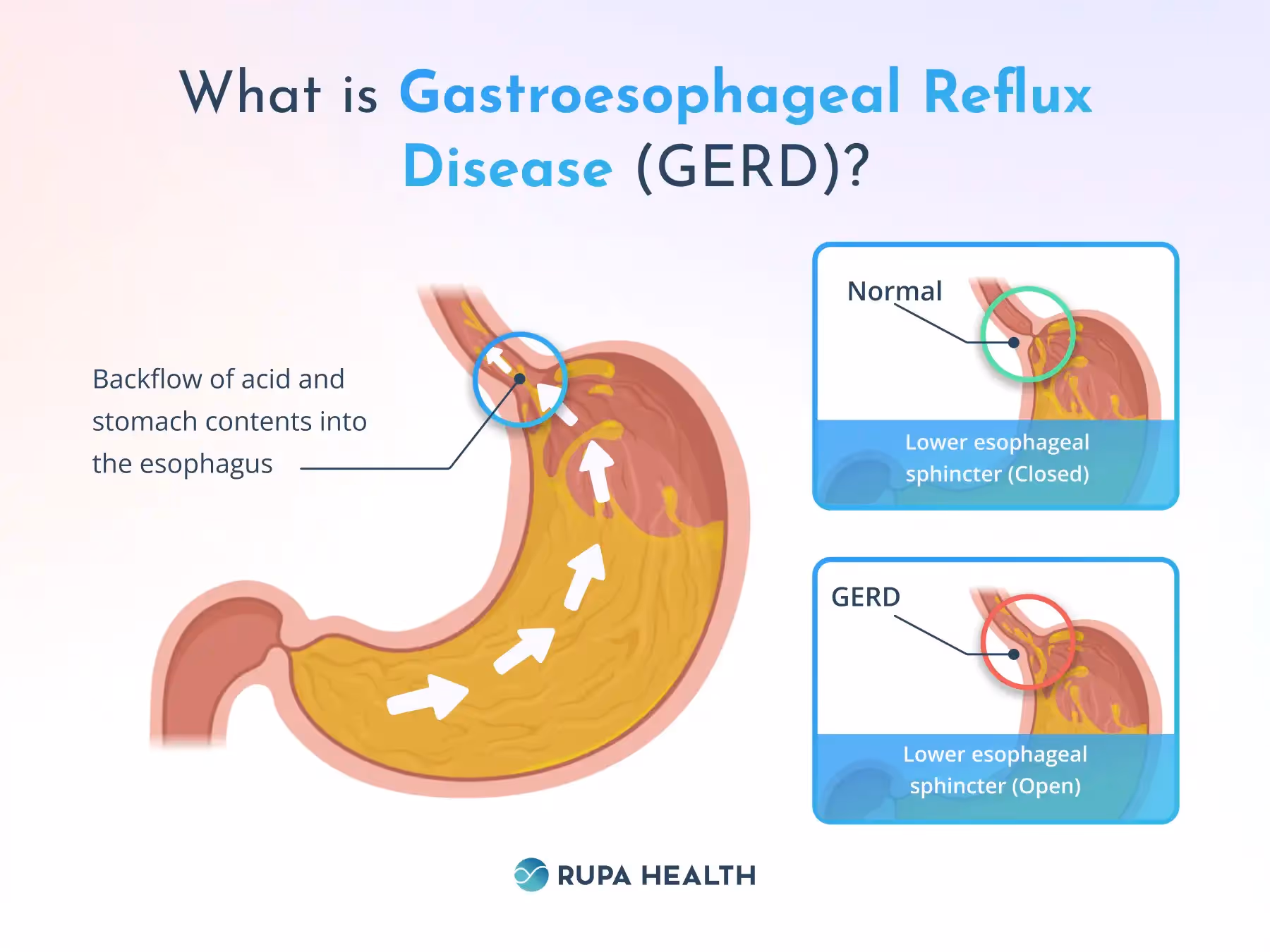 The image is an educational illustration explaining Gastroesophageal Reflux Disease (GERD). It compares the normal state of the lower esophageal sphincter, which is closed, to its state during GERD, where it is open.