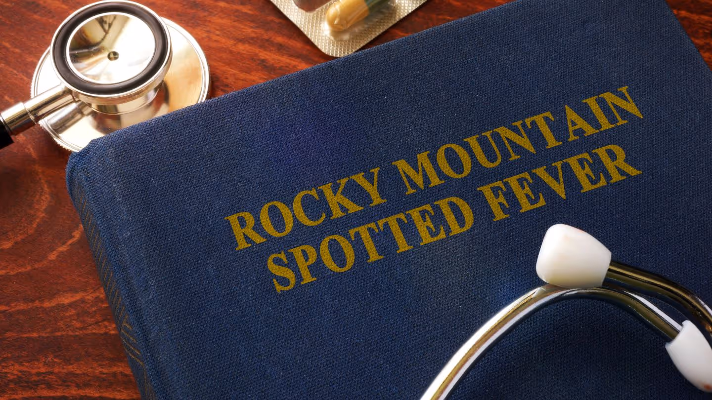 Rocky Mountain Spotted Fever: Symptoms, Diagnosis, & Treatment