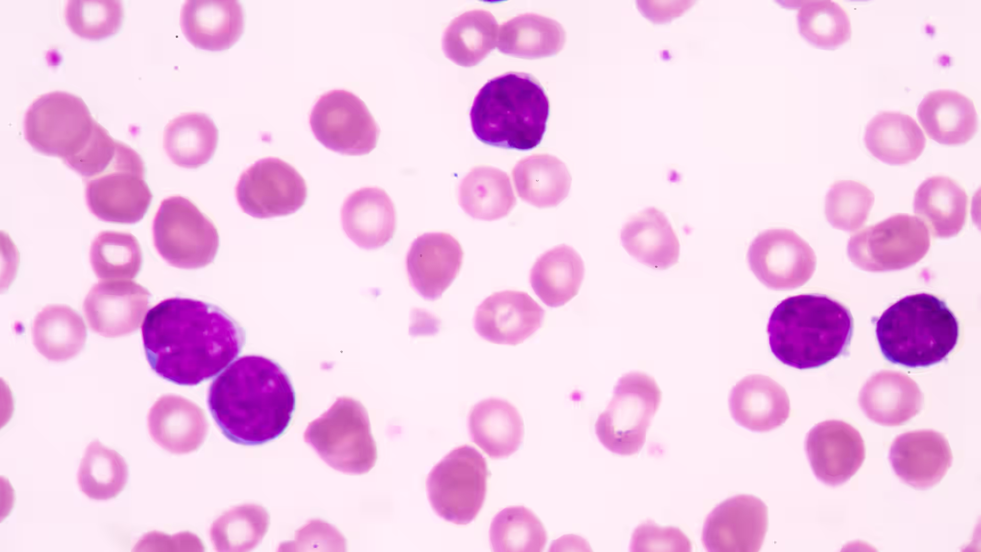 B-Cell Acute Lymphoblastic Leukemia (ALL)