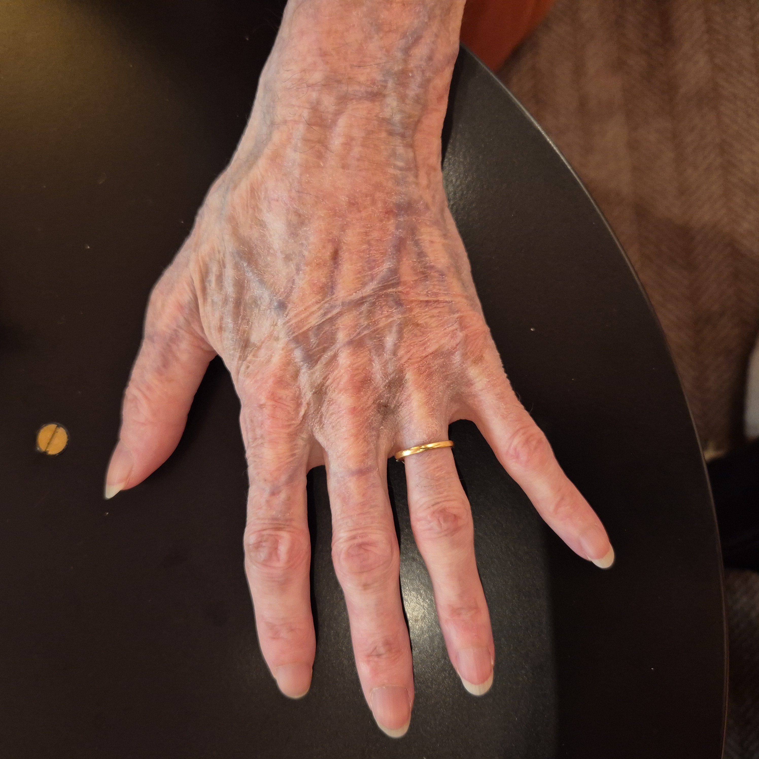 Close-up of a swollen knuckle too large for the ring to slide back over, before using the dental tape removal technique