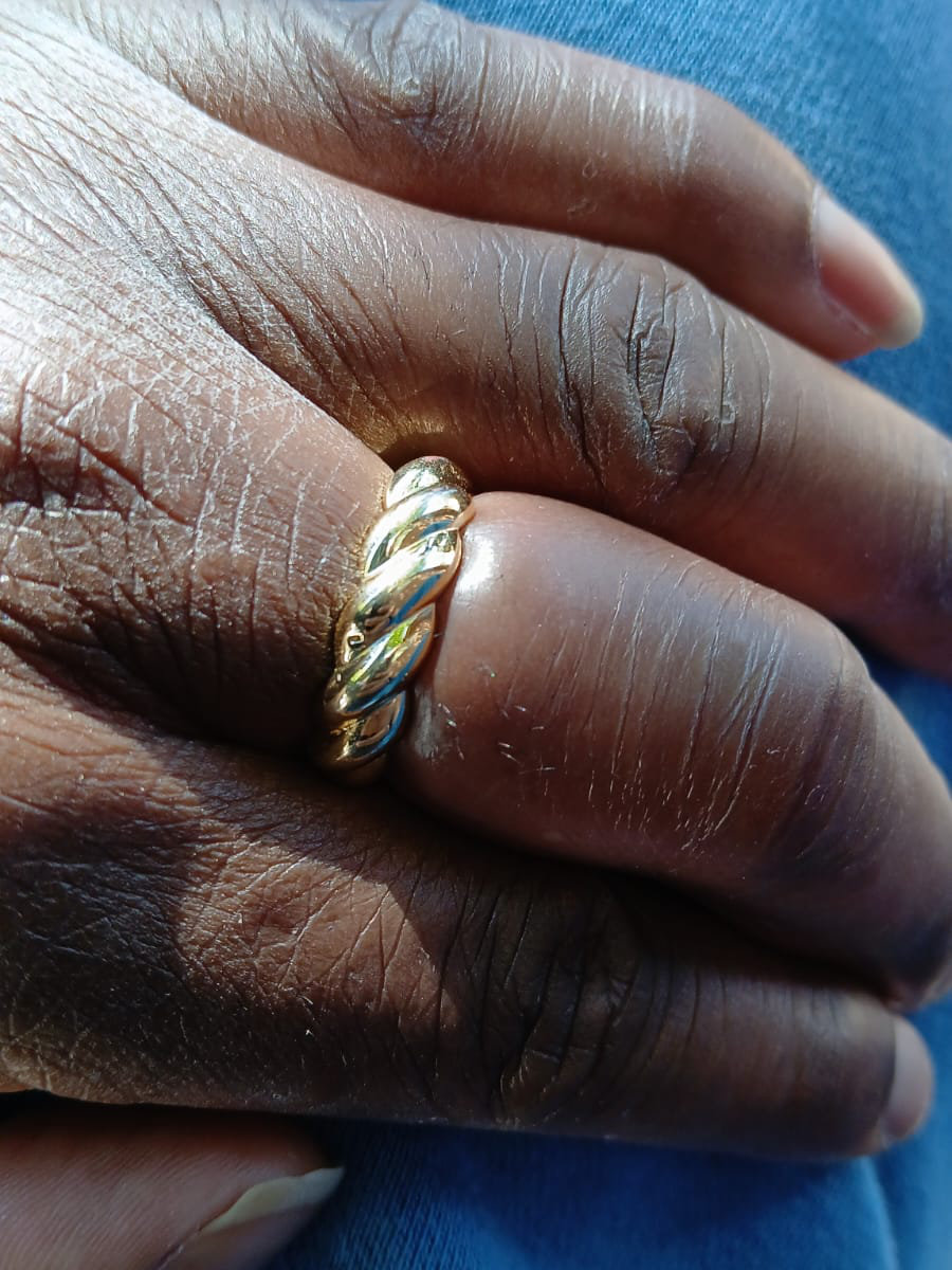 A ring stuck on a swollen finger, showing the skin bulging around the band from restricted circulation