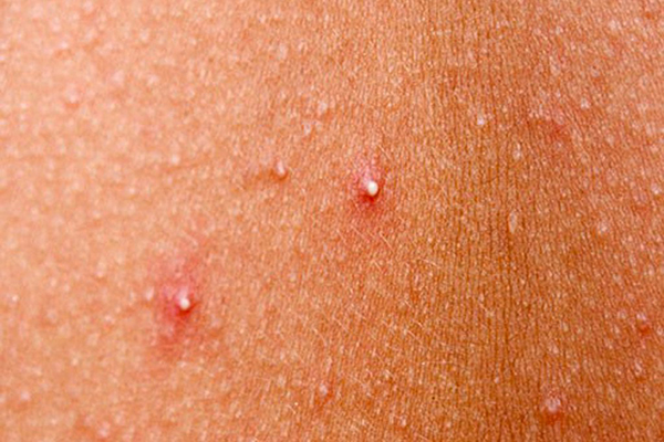 Kem trị mụn VERNICERS ACNE mua bán ở đâu? Giá bao nhiêu? Có tốt không?