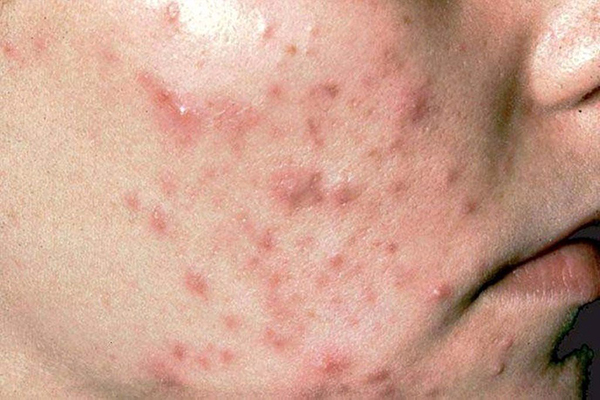 Kem trị mụn VERNICERS ACNE mua bán ở đâu? Giá bao nhiêu? Có tốt không?