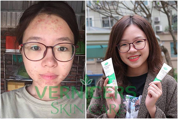 Kem trị mụn VERNICERS ACNE mua bán ở đâu? Giá bao nhiêu? Có tốt không?
