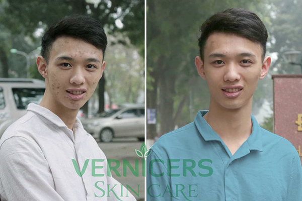 Kem trị mụn VERNICERS ACNE mua bán ở đâu? Giá bao nhiêu? Có tốt không?