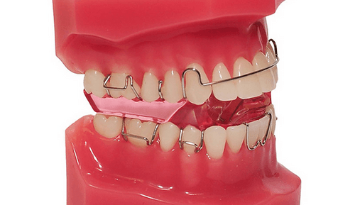 twin block appliance