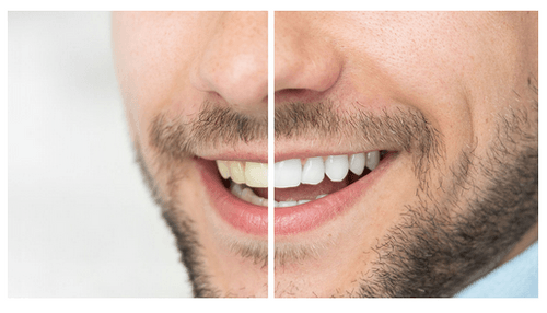 teeth whitening tauranga