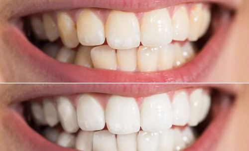 teeth whitening tauranga