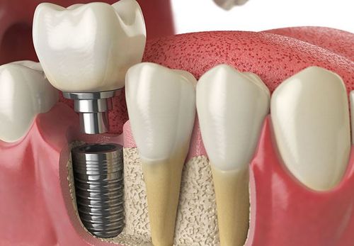 dental implants tauranga