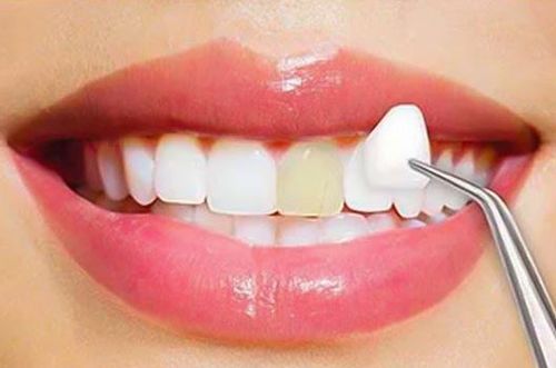 dental veneers tauranga