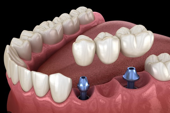 Prosthodontic Treatment Tauranga