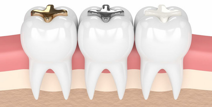 dental filling tauranga