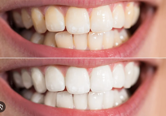 teeth whitening tauranga