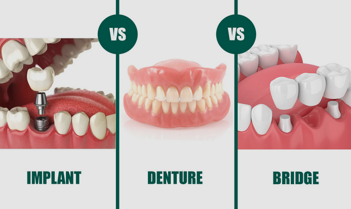 Dental Implants vs Dentures vs Bridges