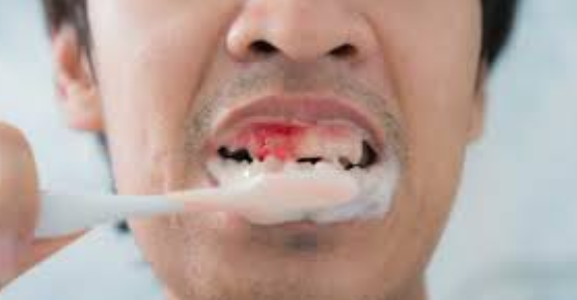 gums bleeding when brushing teeth