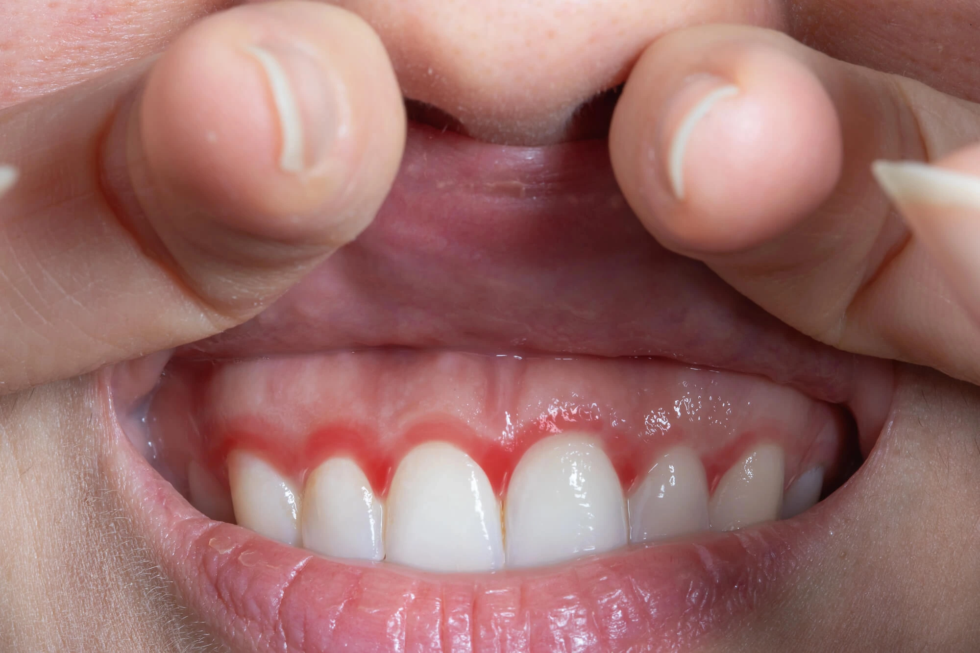 person with gum disease cannot get a dental implant in Tamarac
