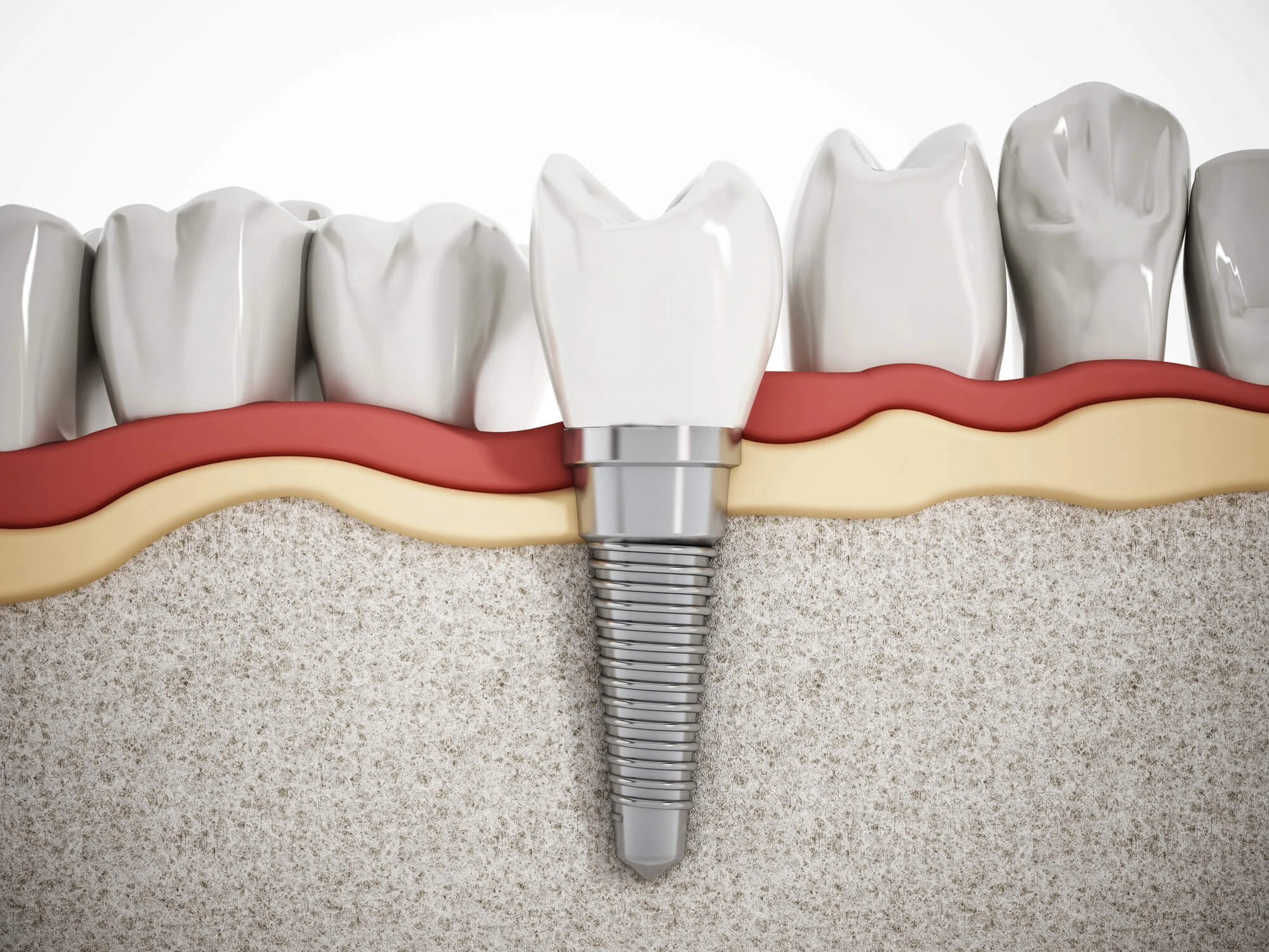 3d render of a dental implant in Tamarac