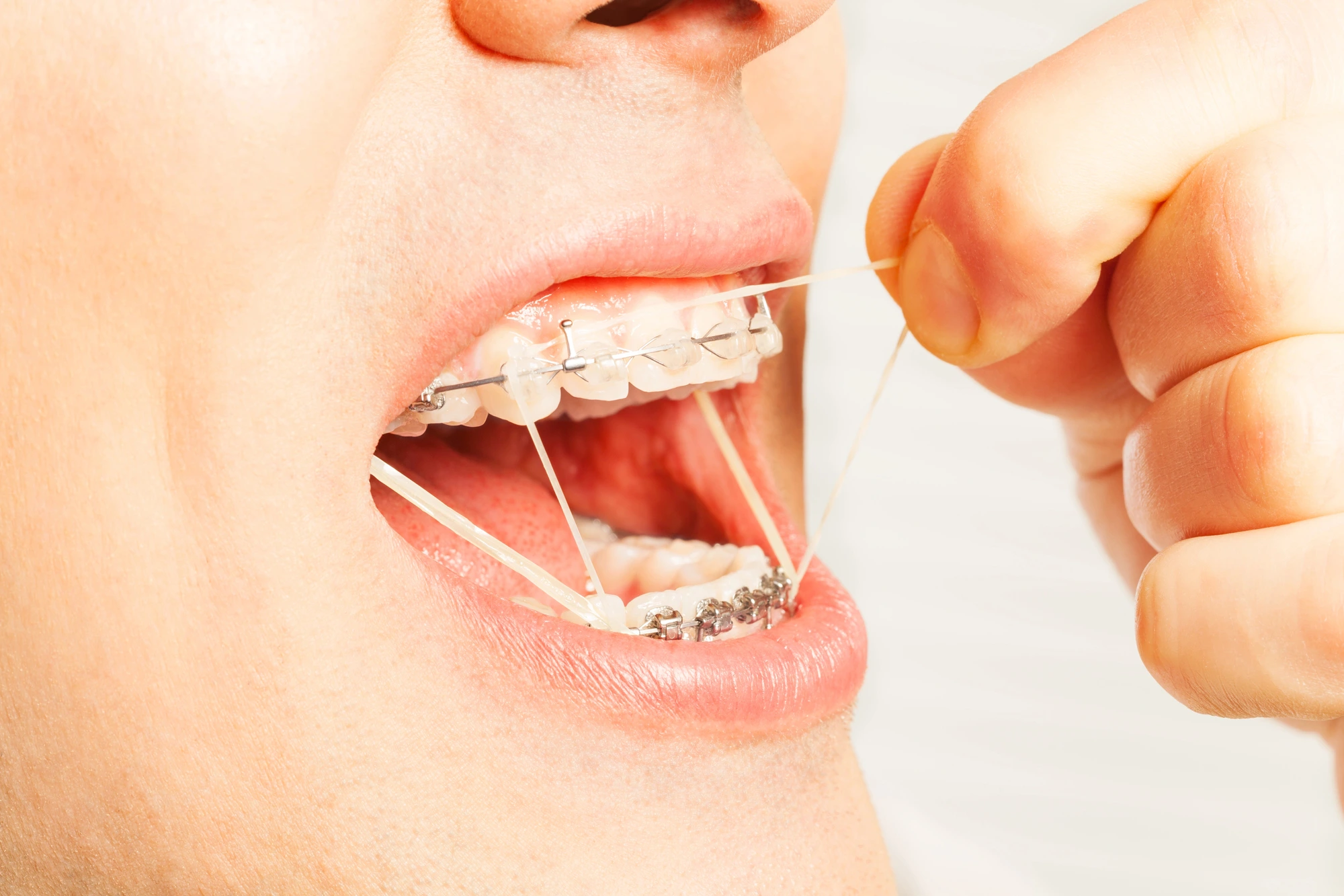 person with braces and elastic bands at orthodontist Ft. Lauderdale