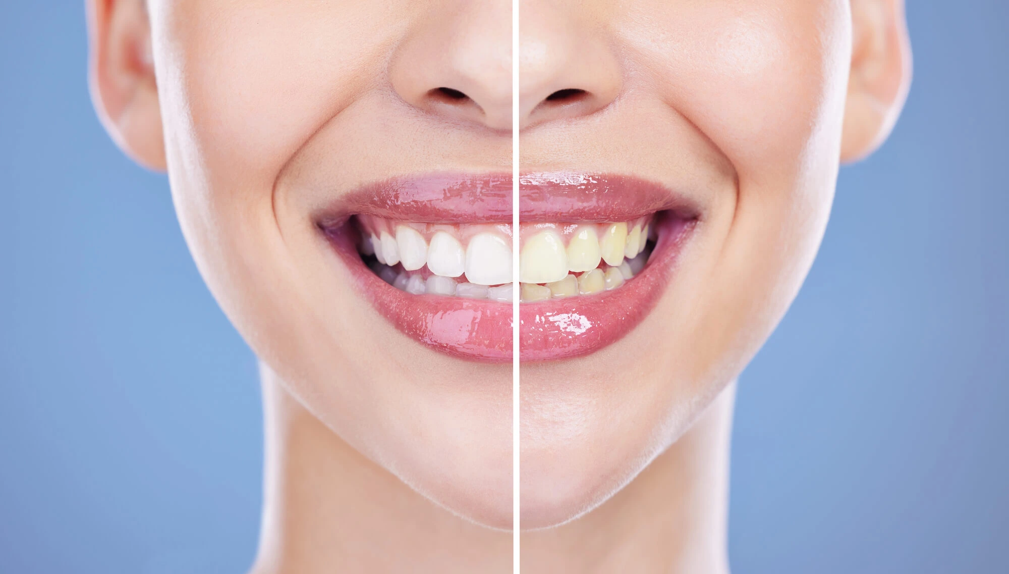 before and after professional teeth cleaning