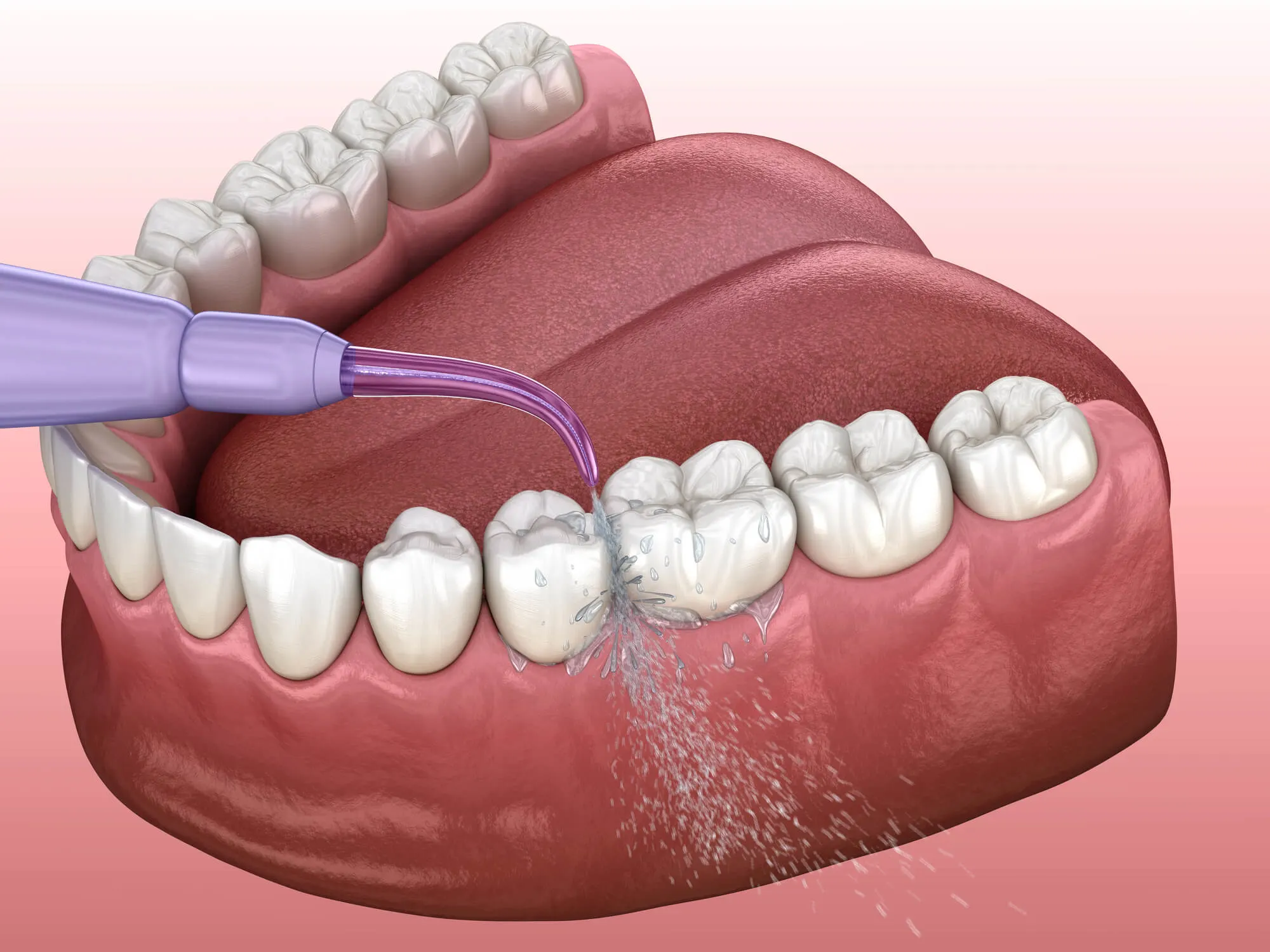 3d image of professional teeth cleaning