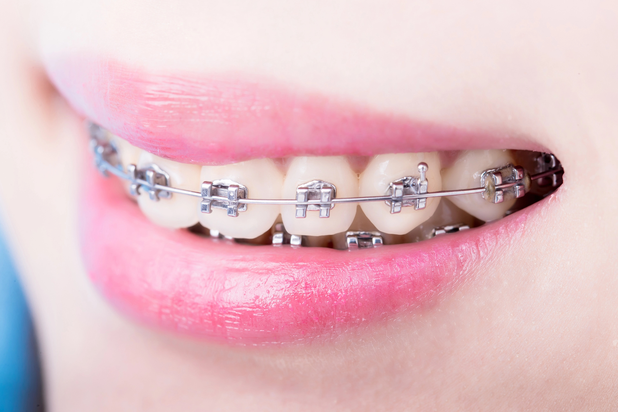 woman smiling and showing her affordable braces