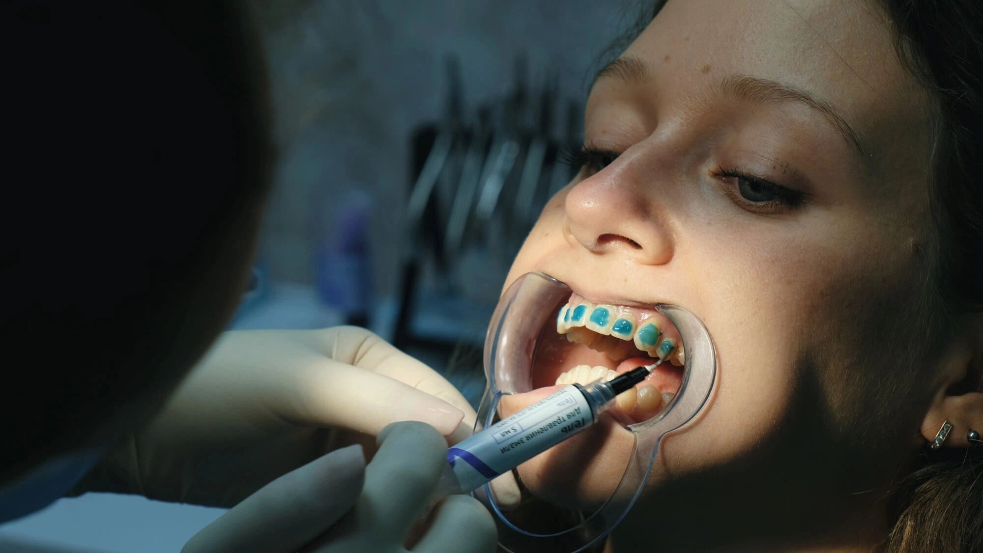 Undergoing affordable braces
