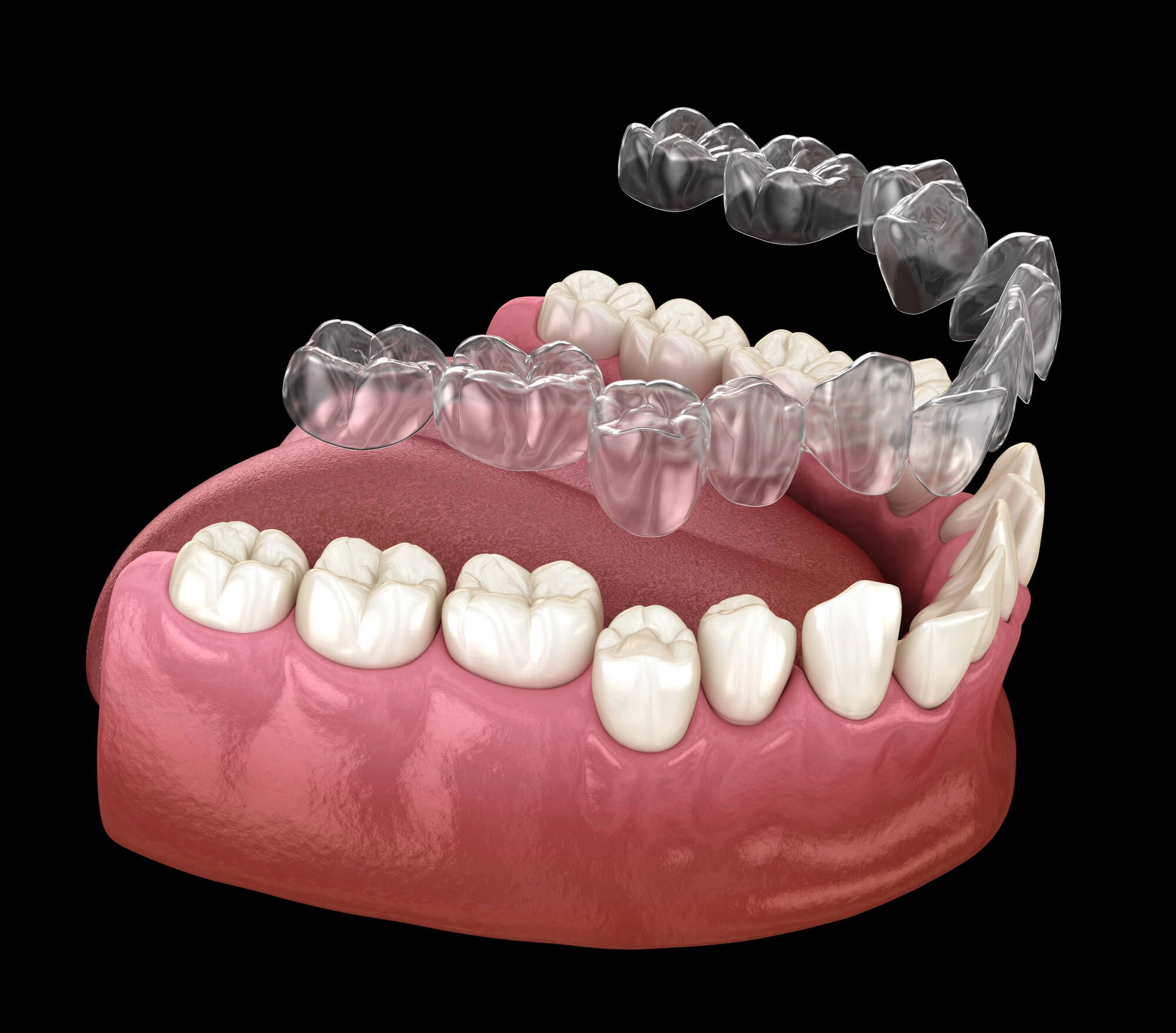affordable Invisalign treatment illustration