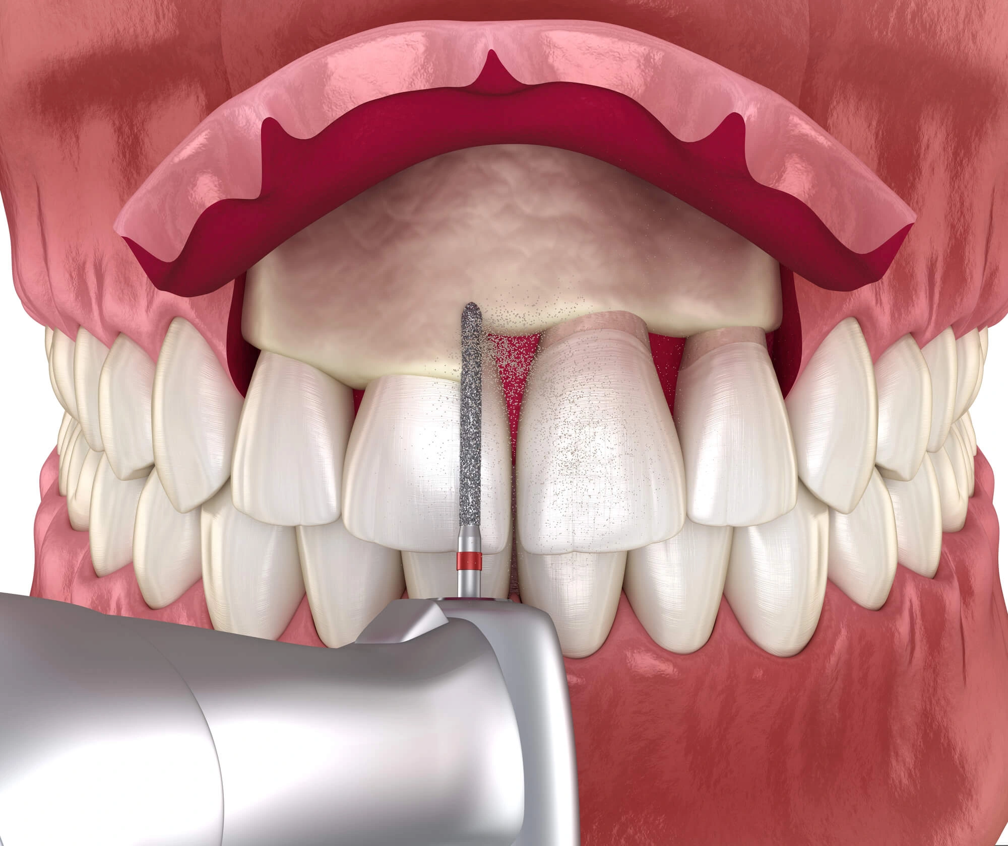 Gum Treatment illustration by dentist Tamarac