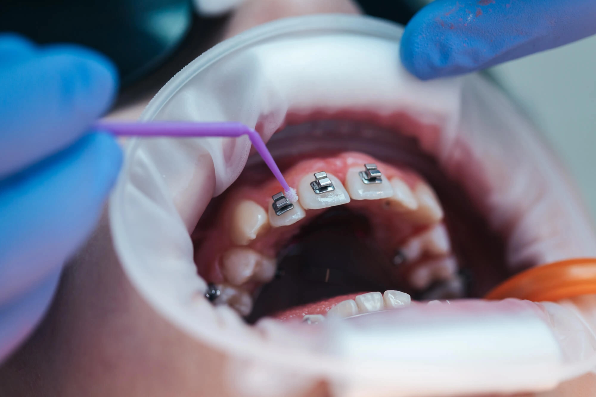 Installing braces hollywood