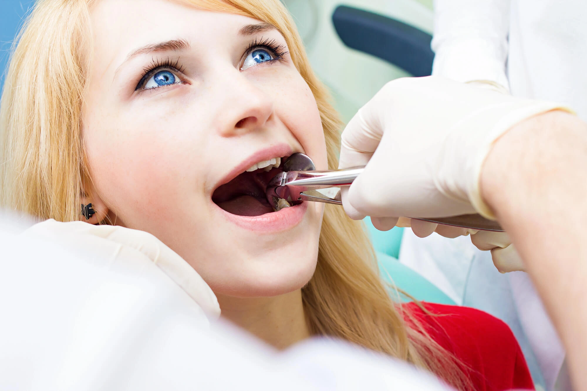 Wisdom tooth extraction by dentist ft lauderdale