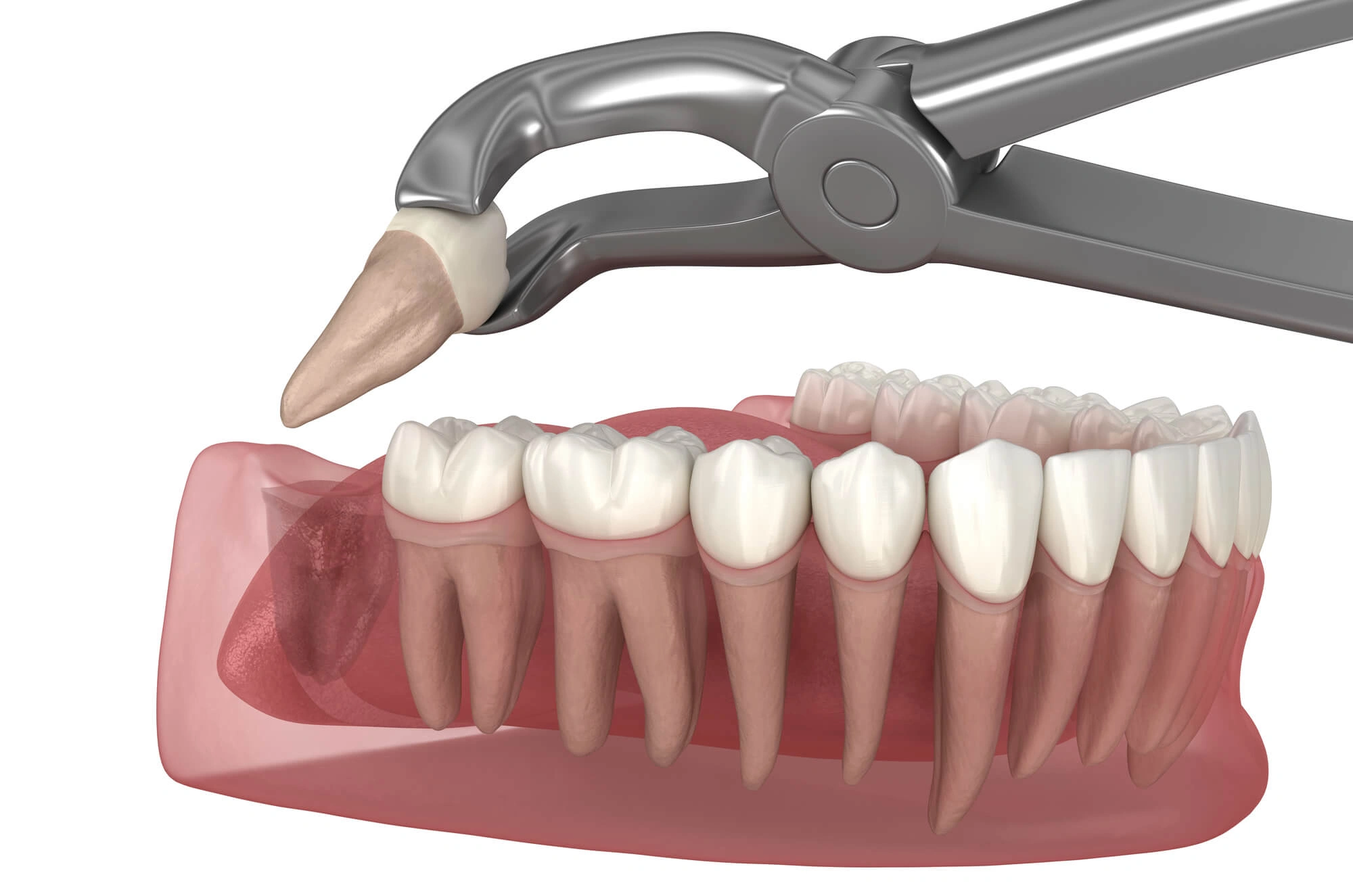 3D Illustration of extraction by dentist ft lauderdale