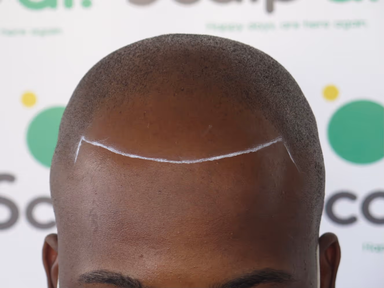SMP for men. Scalp micropigmentation case study 