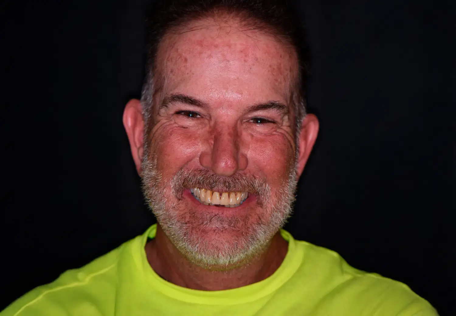 Full Arch Dental Implants