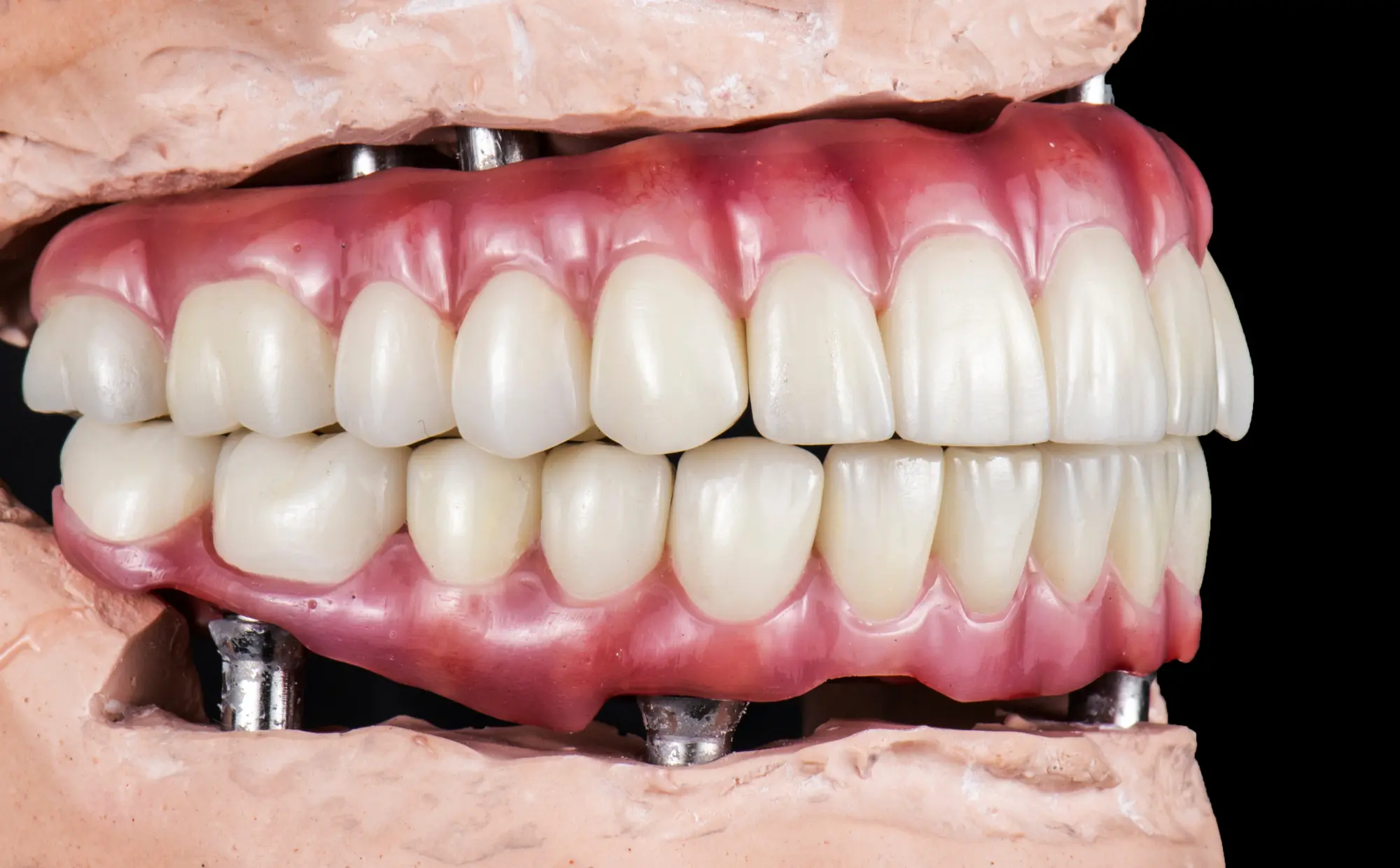 Whether you’re struggling with ill-fitting dentures or avoiding conversations and photos due to gaps in your smile, it’s easy to feel like there’s no lasting solution.