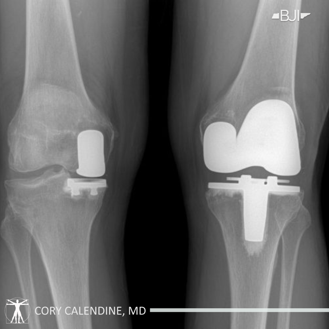 How Painful Is Joint Replacement Surgery?