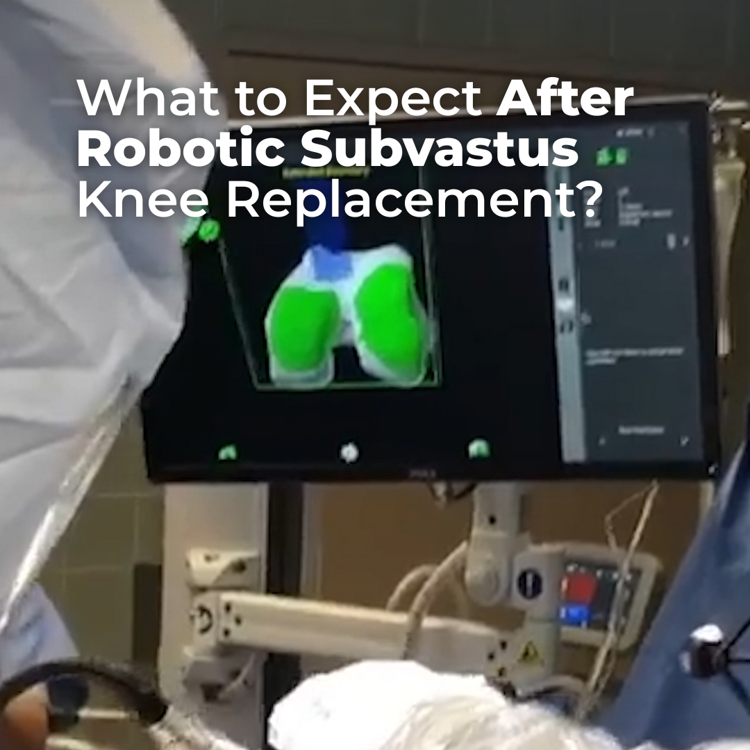 What to Expect After Robotic Subvastus Knee Replacement