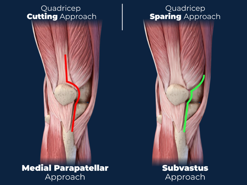 Comparison of quadricep cutting medial parapatellar approach versus quadricep sparing subvastus approach for knee replacement surgery showing incision techniques