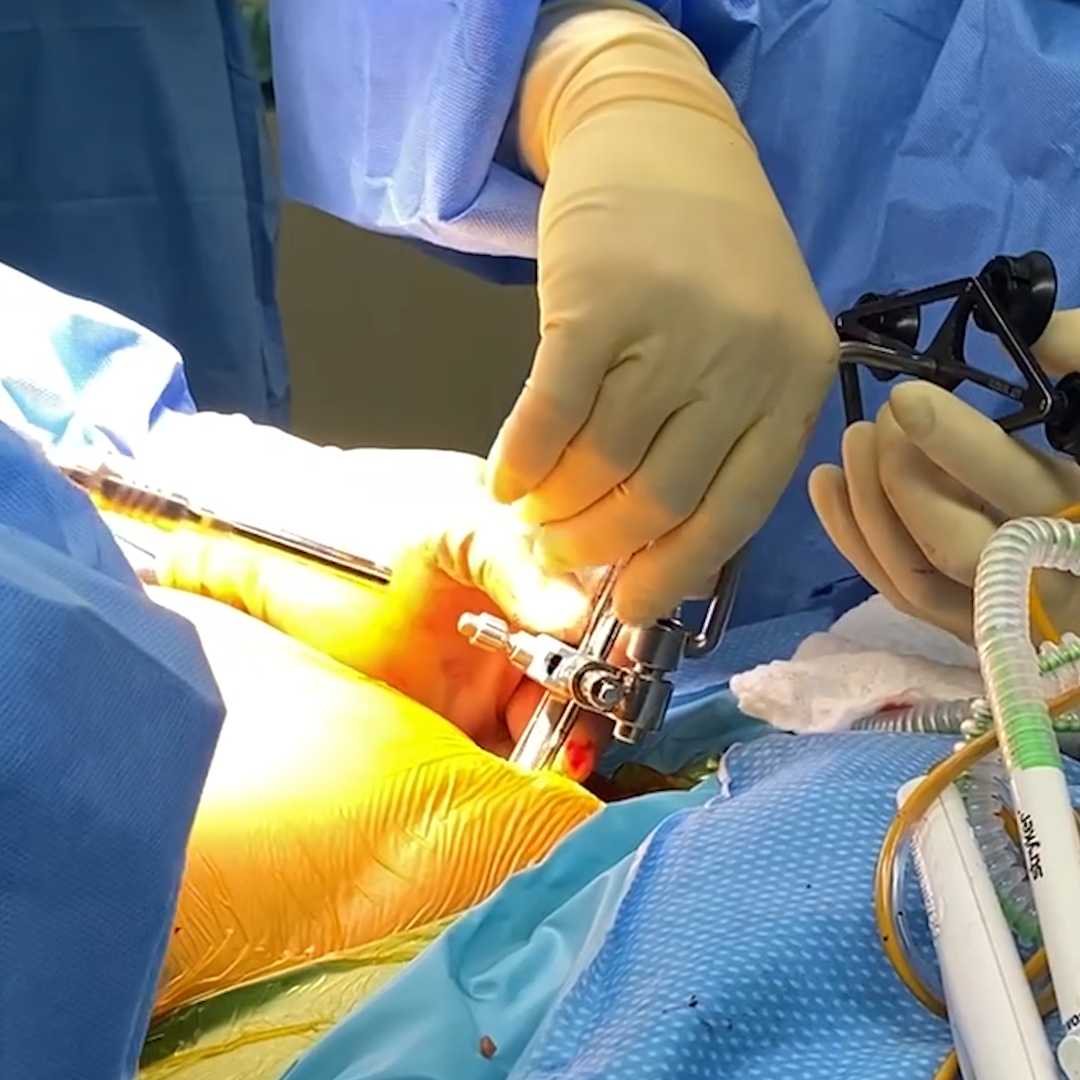 Robotic Knee Replacement: How Tracking Arrays Work During Knee Surgery