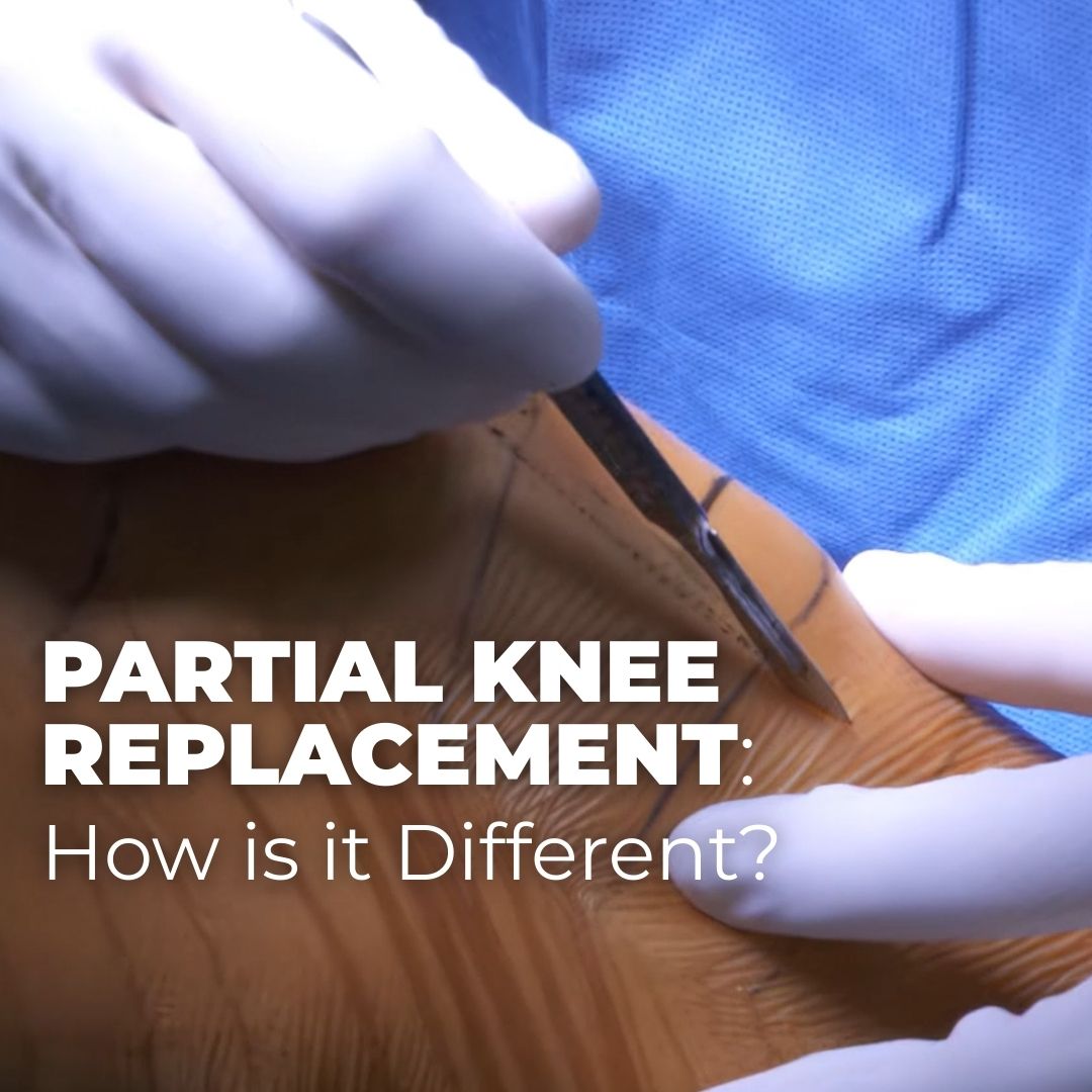 Partial Knee Replacement: How is it Different?