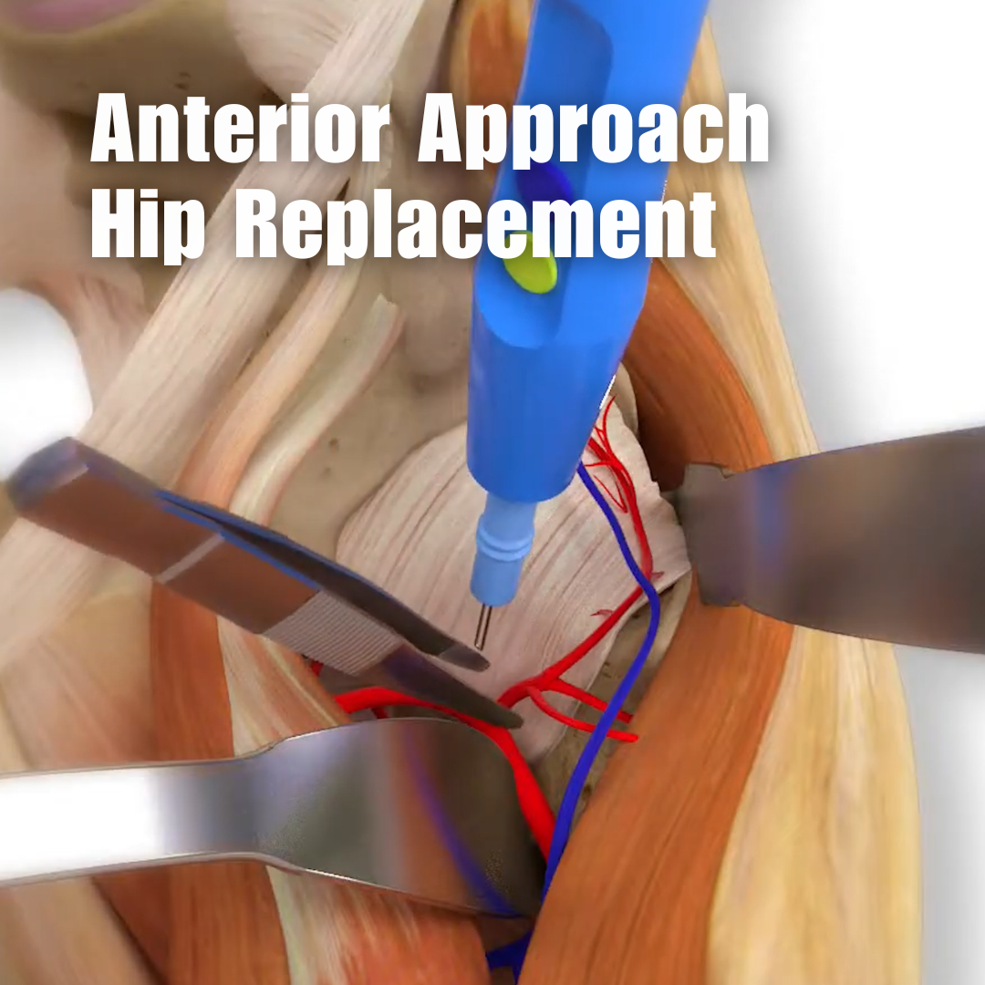 Muscle Sparing Hip Replacement Surgery | Dr. Cory Calendine