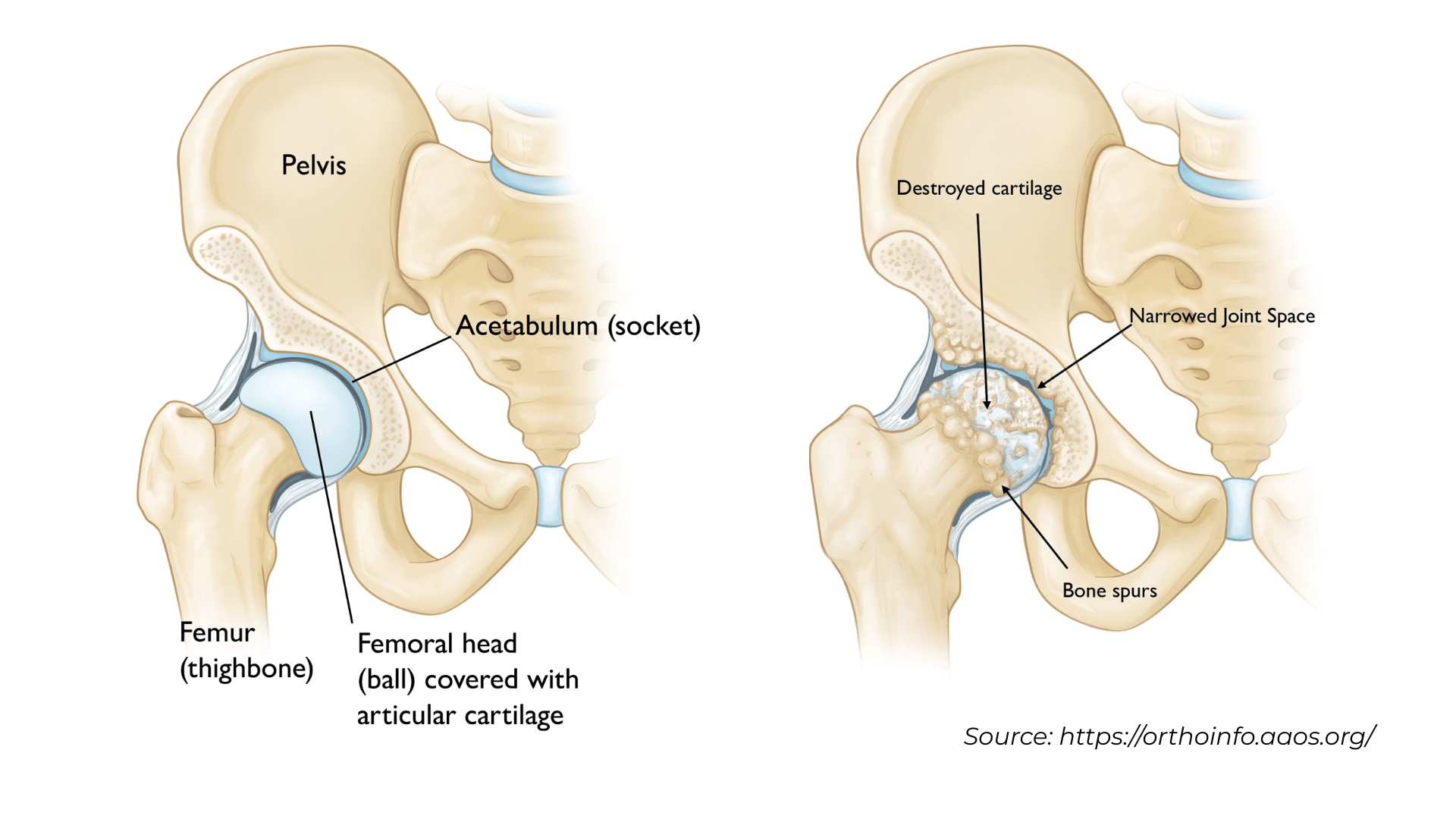 hip bone anatomy and osteoarthritis illustration