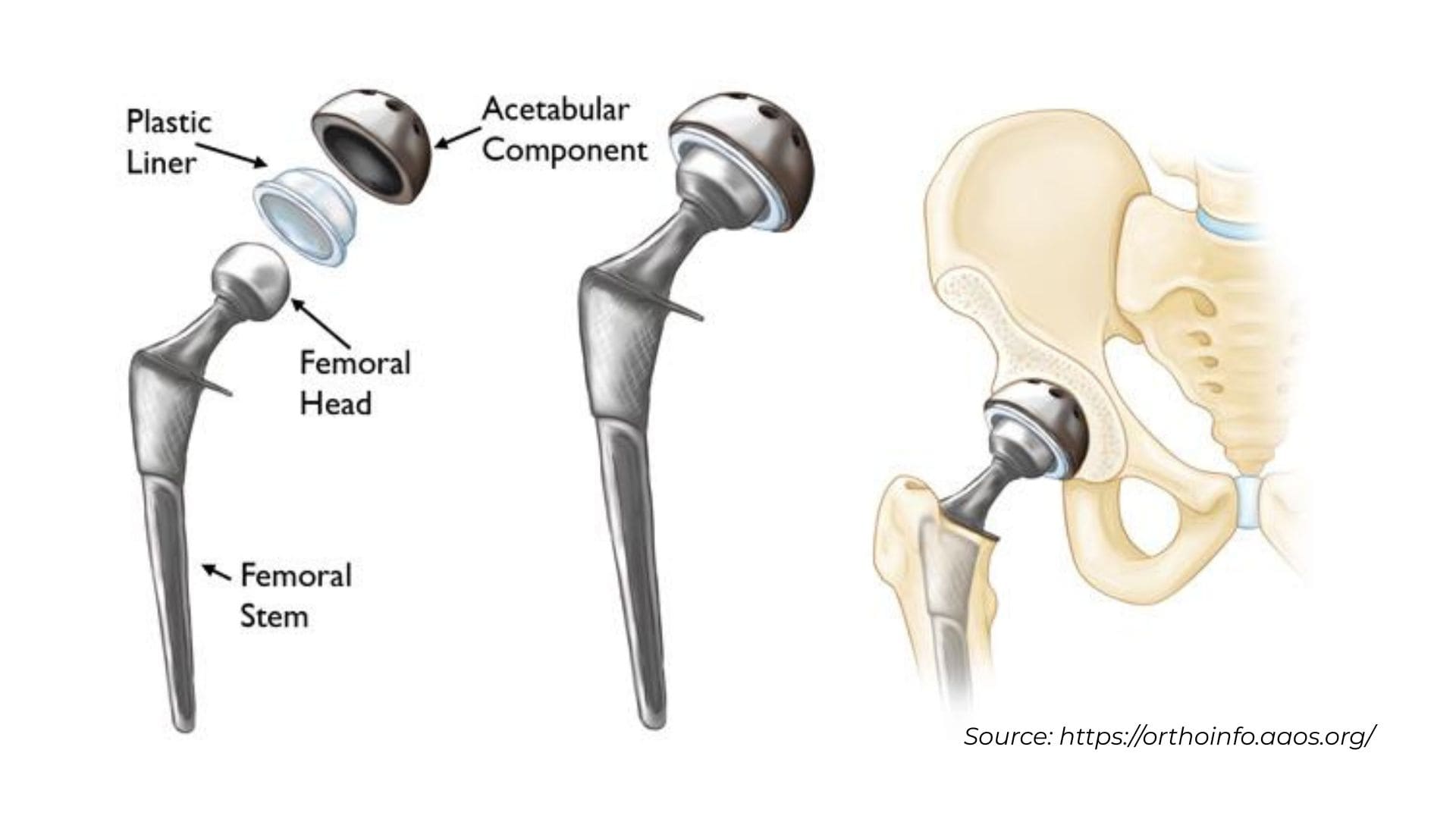 hip replacement implant illustration