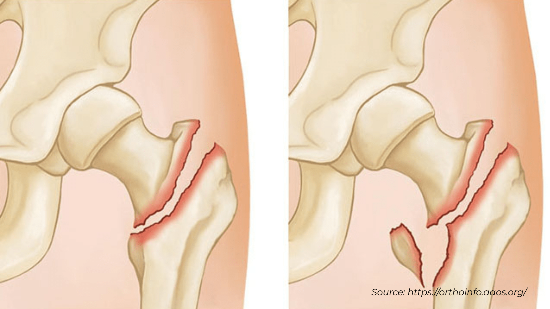 femoral neck fracture classification diagram