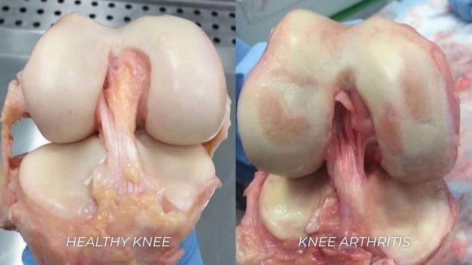 osteoarthritis and rheumatoid arthritis diagram
