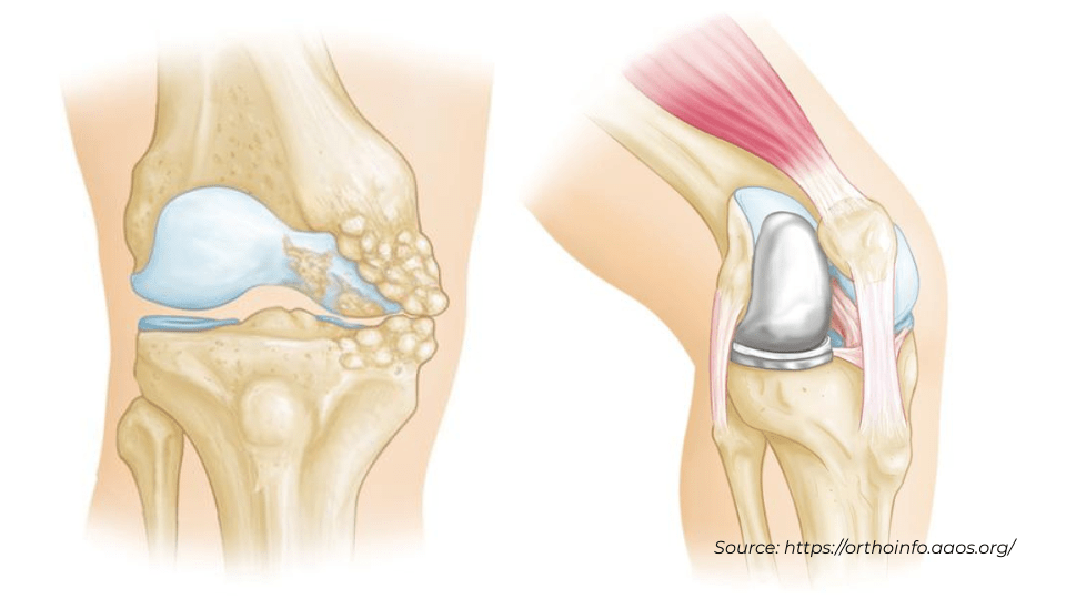 Partial Knee Replacement Illustrion