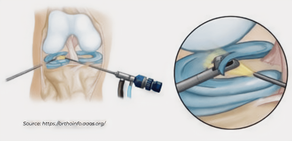 knee arthroscopy anatomy diagram