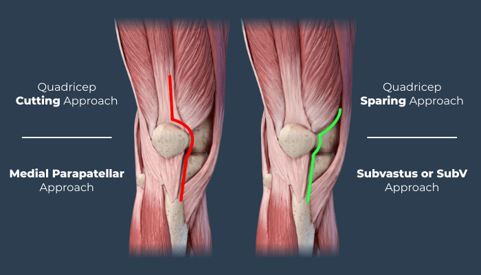 Medical diagram comparing quadriceps cutting medial parapatellar approach versus quadriceps sparing subvastus approach for knee replacement surgery showing muscle preservation technique